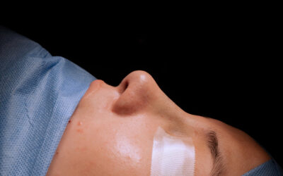 Precio de rinoplastia ultrasónica