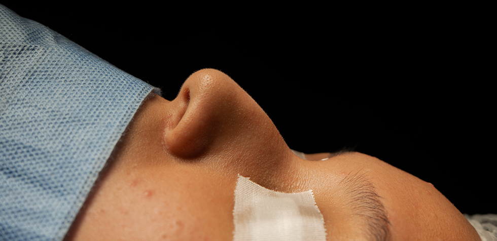 Cómo acelerar la cicatrización después de una rinoplastía