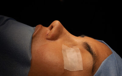 Rinoplastia ultrasónica en Lima