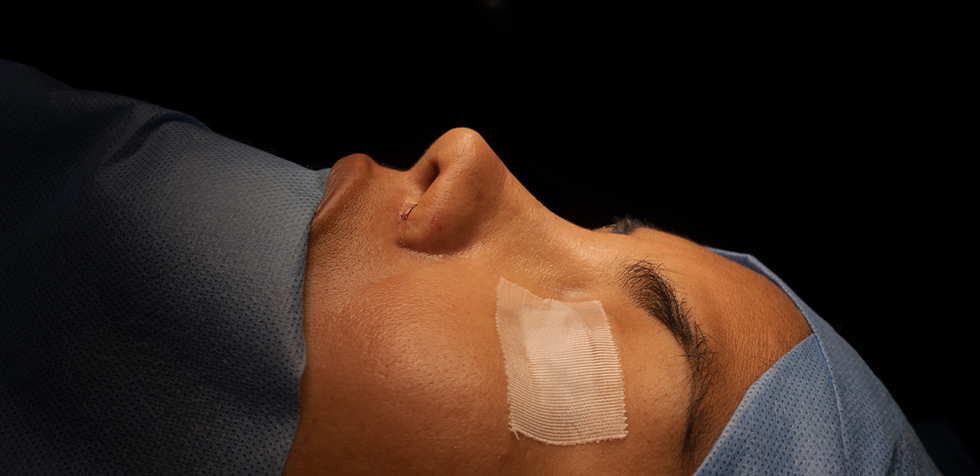 Rinoplastia ultrasónica en Lima