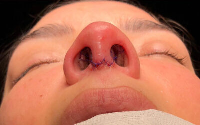 Evita la fibrosis después de una rinoplastia: guía completa para una recuperación exitosa