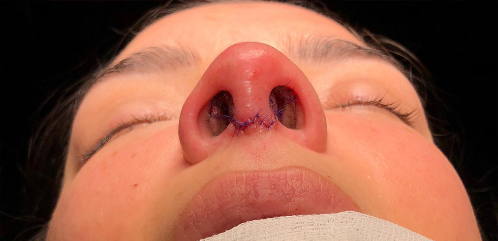 rinoplastia en fibrosis