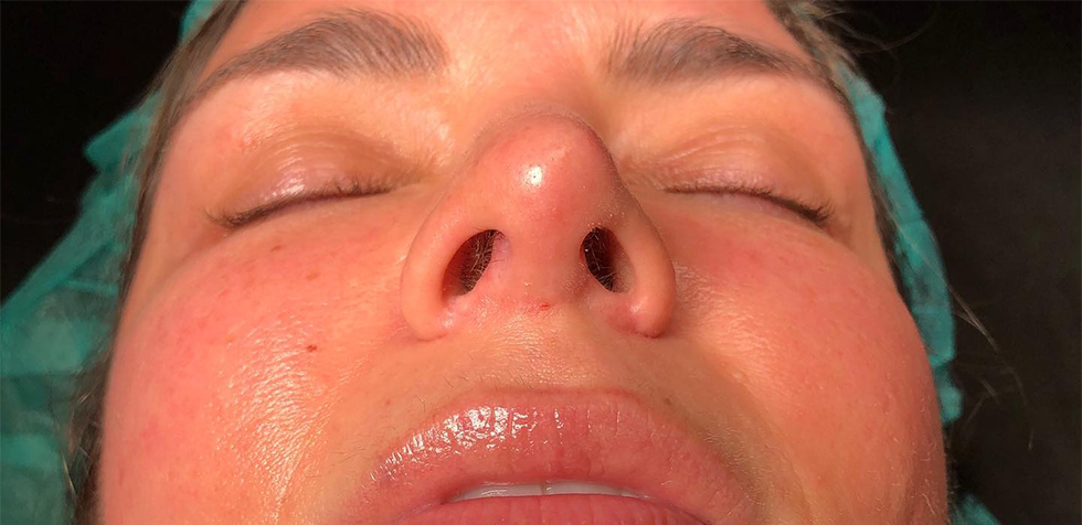 evita la fibrosis después de una rinoplastia