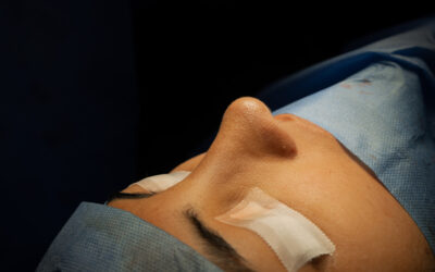 Dr. Guanilo: Rinoplastia ultrasonica precio