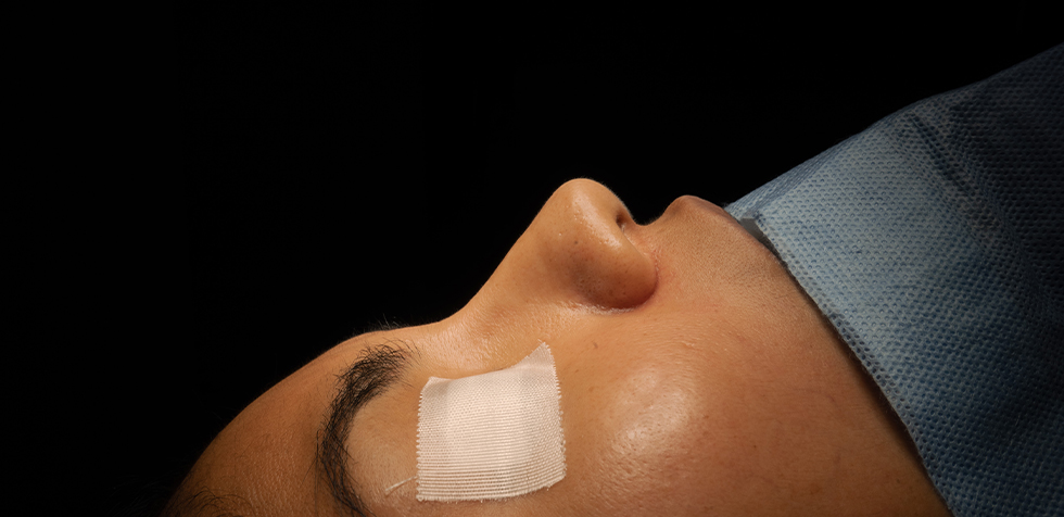 cirugia de nariz rinoplastia