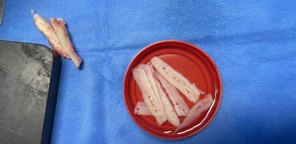 cartilago de costilla