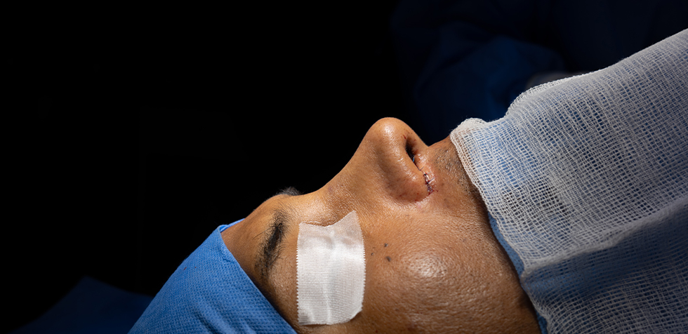errores en rinoplastia