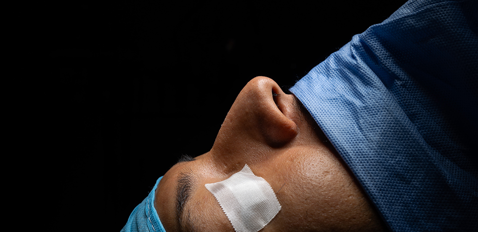 rinoplastia antes
